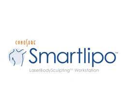 Smartlipo